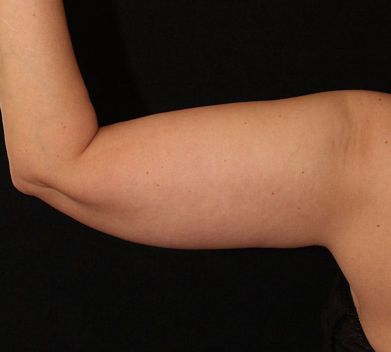 Bodytite Before & After Gallery - Patient 262913 - Image 5
