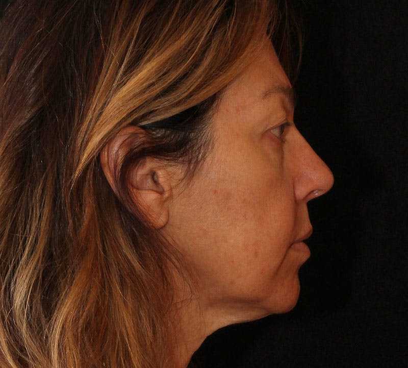 Browlift/Upper Blepharoplasty Before & After Gallery - Patient 394026 - Image 5