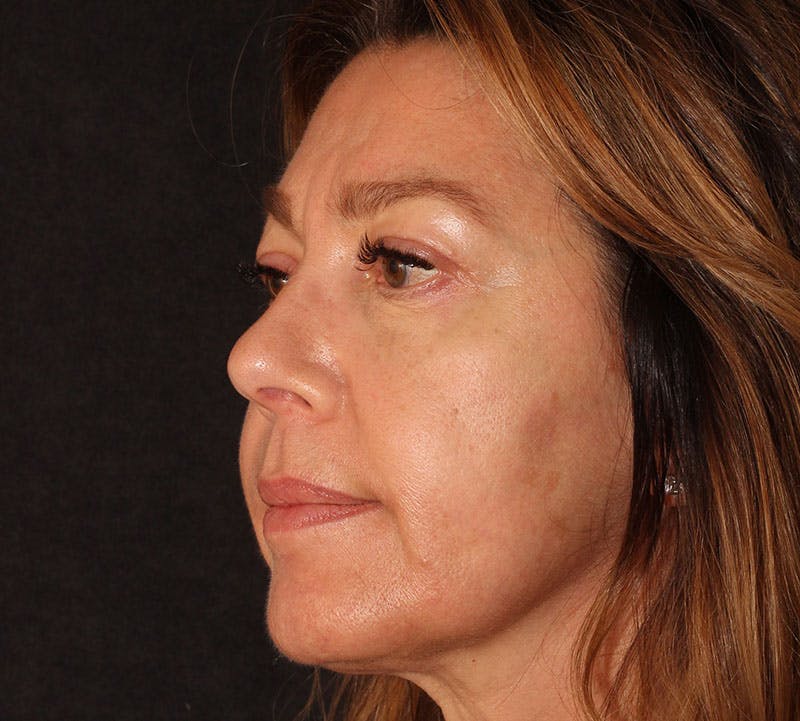 Browlift/Upper Blepharoplasty Before & After Gallery - Patient 394026 - Image 10