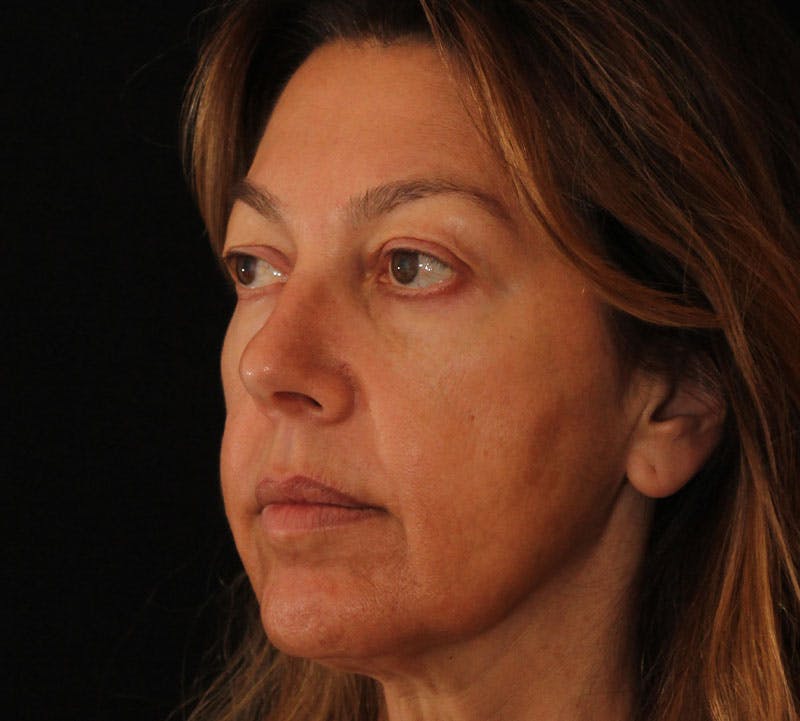 Browlift/Upper Blepharoplasty Before & After Gallery - Patient 394026 - Image 9