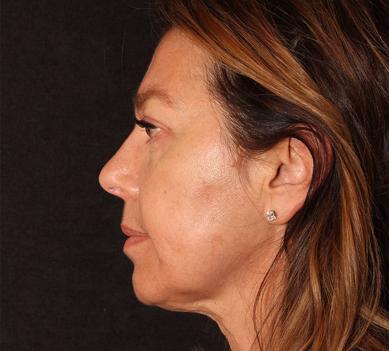 Browlift/Upper Blepharoplasty Before & After Gallery - Patient 394026 - Image 8