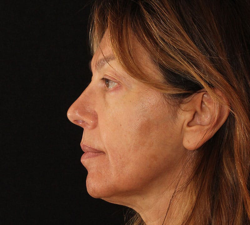 Browlift/Upper Blepharoplasty Before & After Gallery - Patient 394026 - Image 7