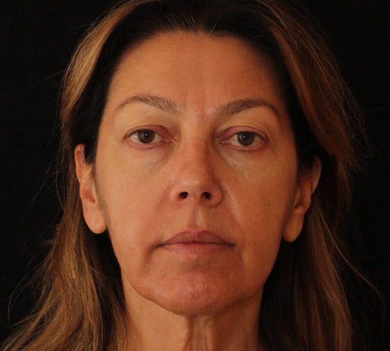 Browlift/Upper Blepharoplasty Before & After Gallery - Patient 394026 - Image 1