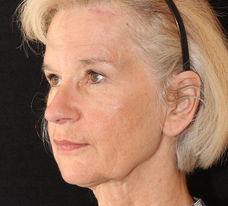Browlift/Upper Blepharoplasty Before & After Gallery - Patient 204350 - Image 10