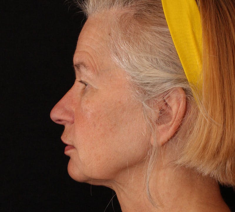 Browlift/Upper Blepharoplasty Before & After Gallery - Patient 204350 - Image 7