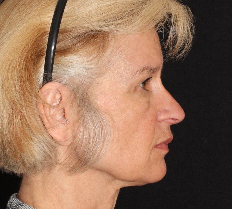 Browlift/Upper Blepharoplasty Before & After Gallery - Patient 204350 - Image 6