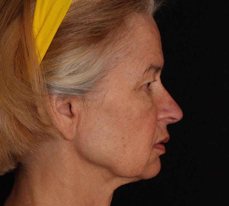 Browlift/Upper Blepharoplasty Before & After Gallery - Patient 204350 - Image 5