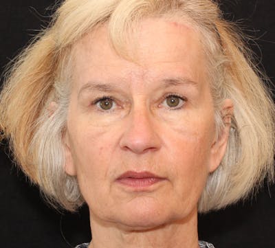 Browlift/Upper Blepharoplasty Before & After Gallery - Patient 204350 - Image 2