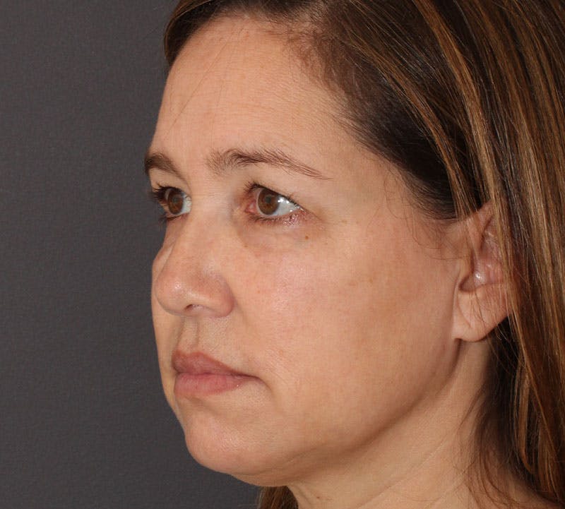 Browlift/Upper Blepharoplasty Before & After Gallery - Patient 214339 - Image 9