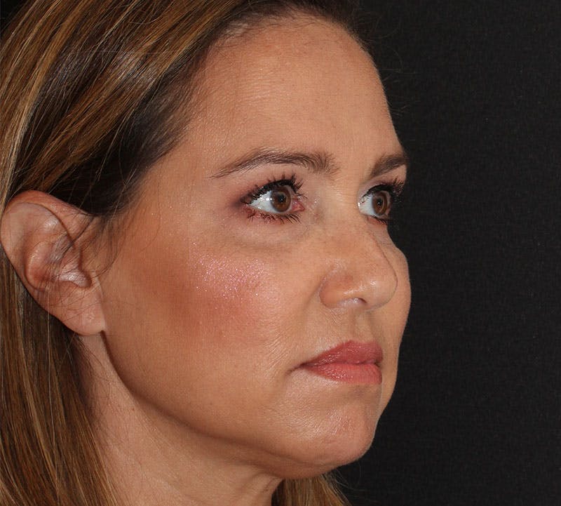 Browlift/Upper Blepharoplasty Before & After Gallery - Patient 214339 - Image 4