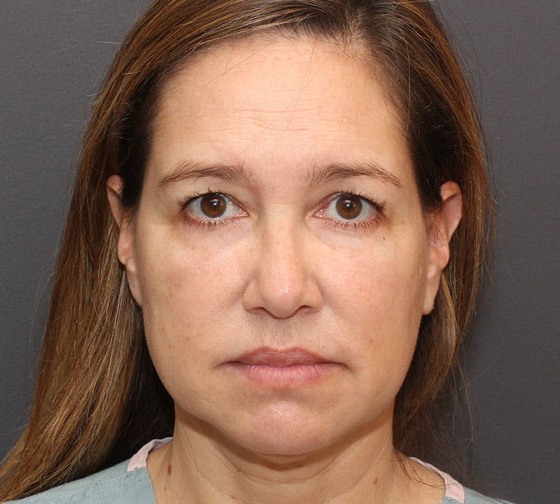 Browlift/Upper Blepharoplasty Before & After Gallery - Patient 214339 - Image 1