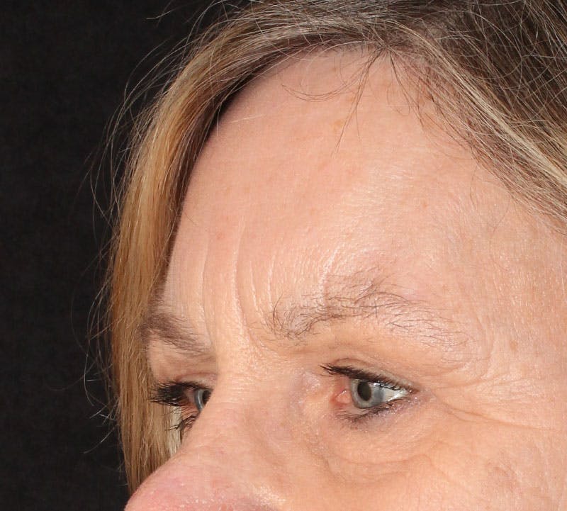 Browlift/Upper Blepharoplasty Before & After Gallery - Patient 234250 - Image 10