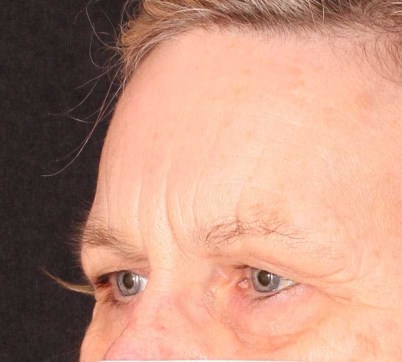 Browlift/Upper Blepharoplasty Before & After Gallery - Patient 234250 - Image 9