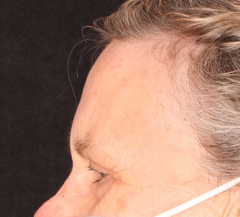 Browlift/Upper Blepharoplasty Before & After Gallery - Patient 234250 - Image 7