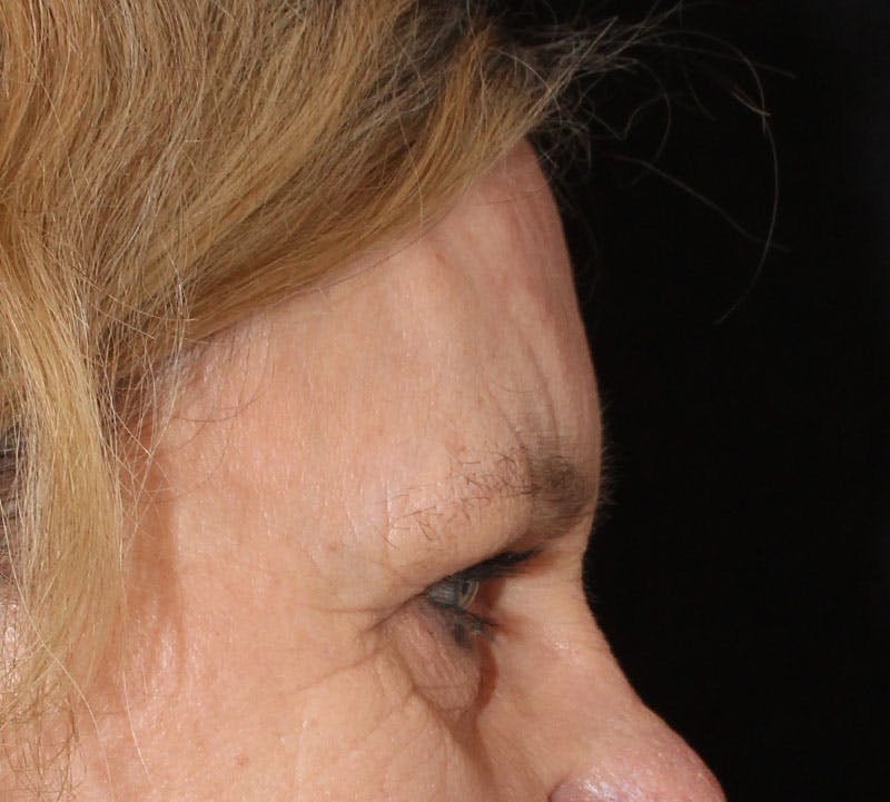 Browlift/Upper Blepharoplasty Before & After Gallery - Patient 234250 - Image 6