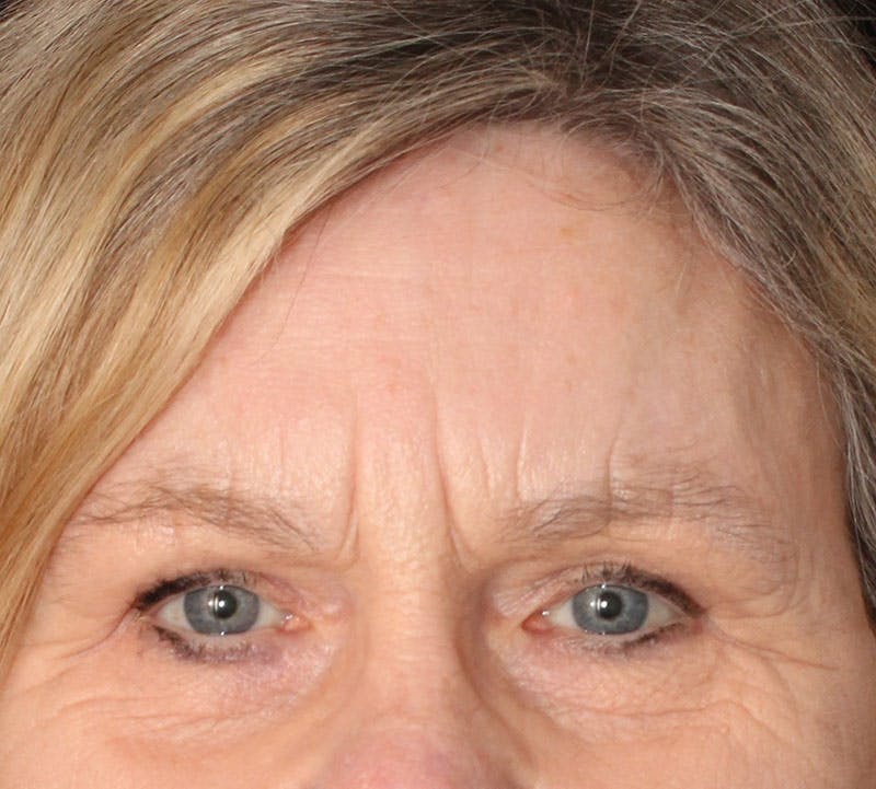 Browlift/Upper Blepharoplasty Before & After Gallery - Patient 234250 - Image 2