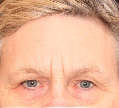 Browlift/Upper Blepharoplasty Before & After Gallery - Patient 234250 - Image 1