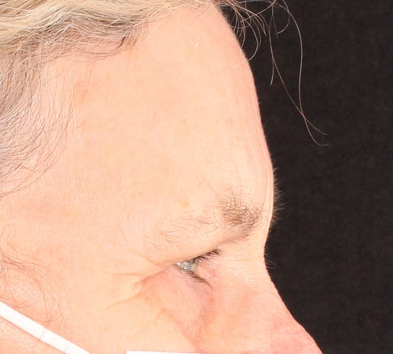 Browlift/Upper Blepharoplasty Before & After Gallery - Patient 234250 - Image 5
