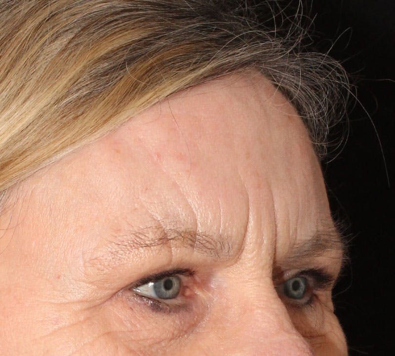 Browlift/Upper Blepharoplasty Before & After Gallery - Patient 234250 - Image 4
