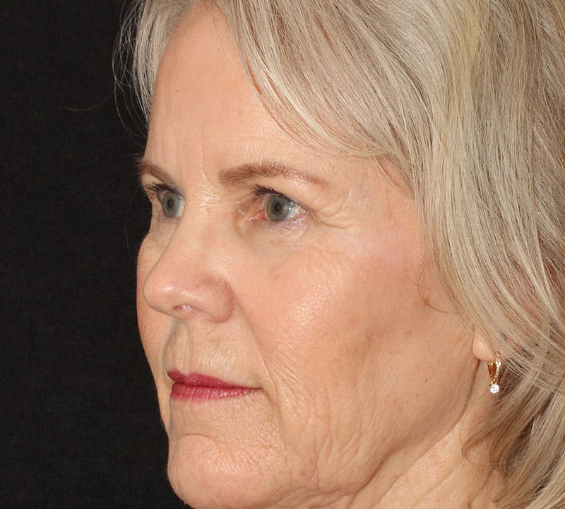 Browlift/Upper Blepharoplasty Before & After Gallery - Patient 281854 - Image 10