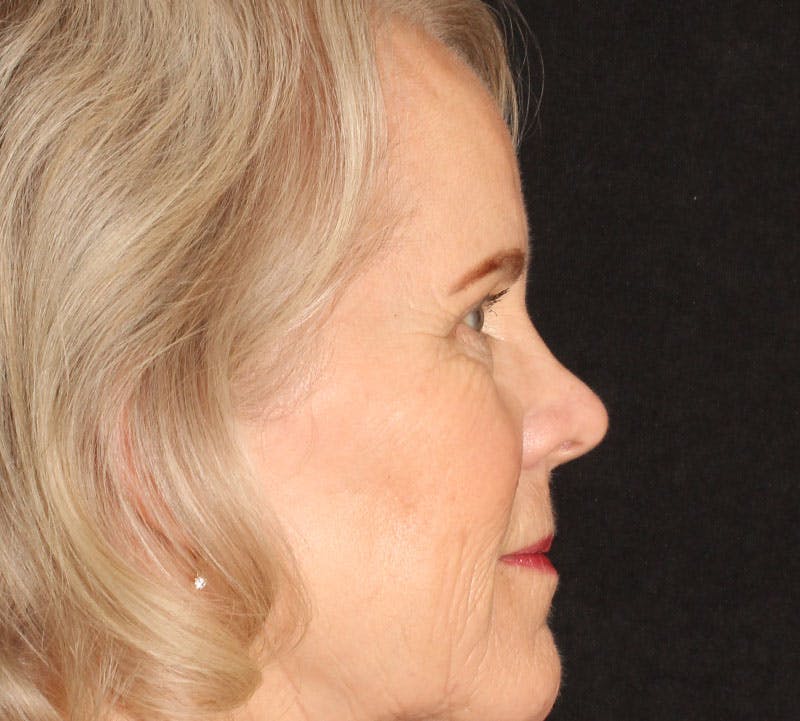 Browlift/Upper Blepharoplasty Before & After Gallery - Patient 281854 - Image 6