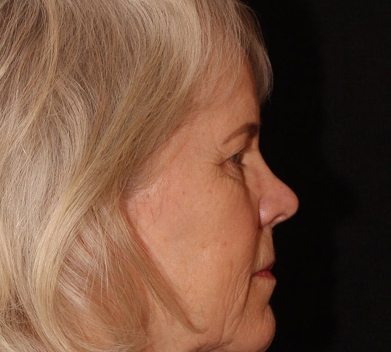Browlift/Upper Blepharoplasty Before & After Gallery - Patient 281854 - Image 5
