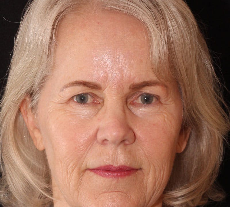 Browlift/Upper Blepharoplasty Before & After Gallery - Patient 281854 - Image 1