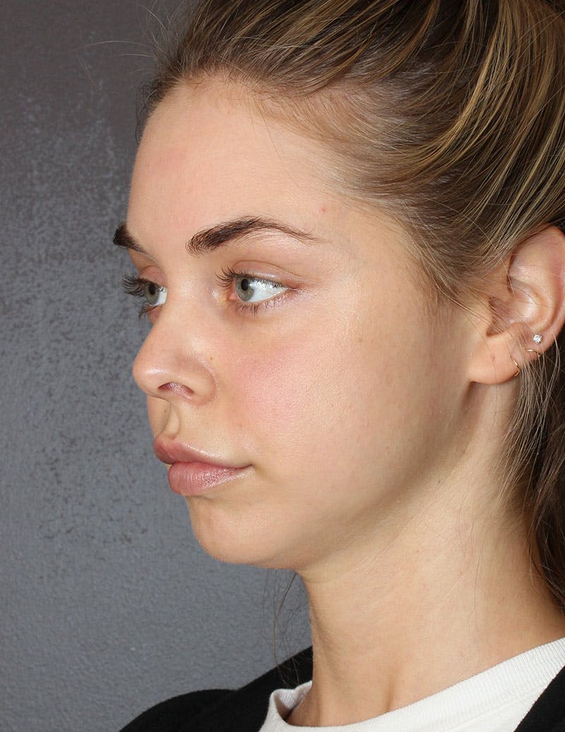 Facetite Before & After Gallery - Patient 298127 - Image 9
