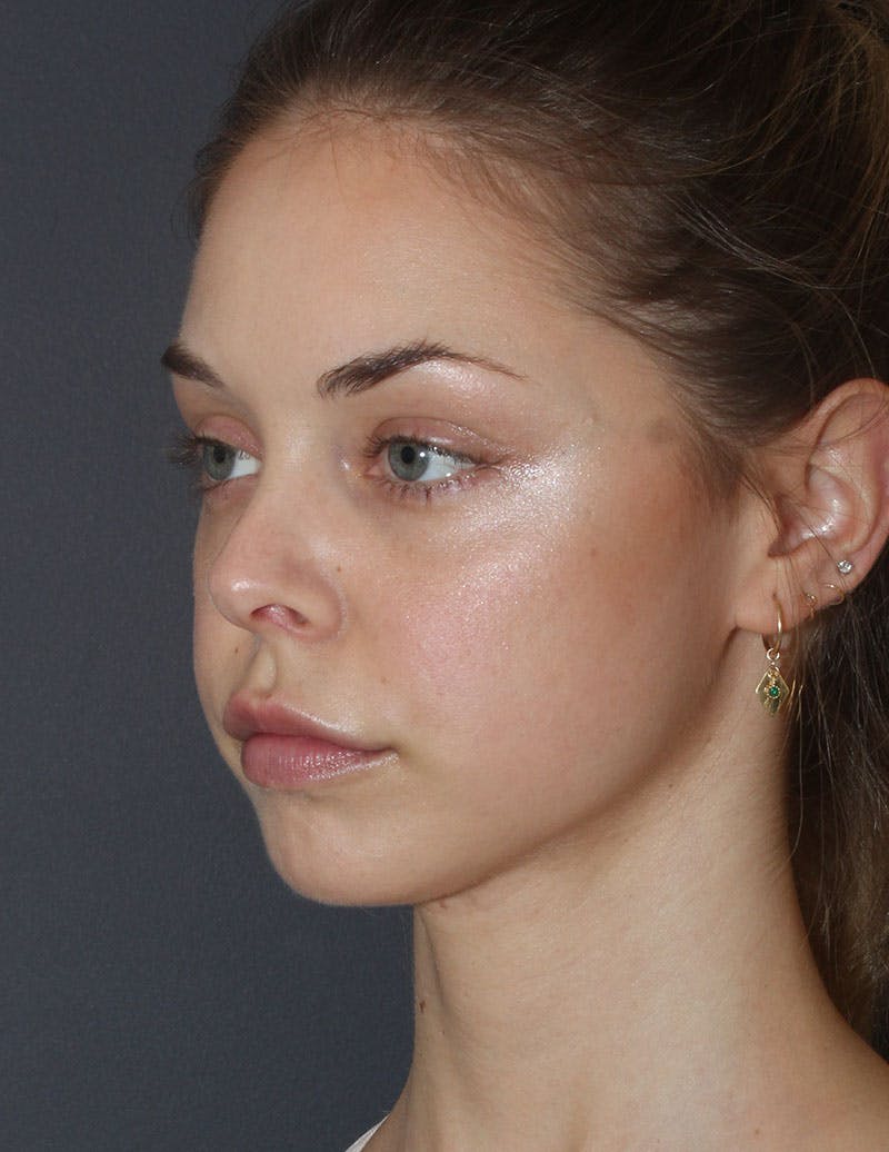 Facetite Before & After Gallery - Patient 298127 - Image 10