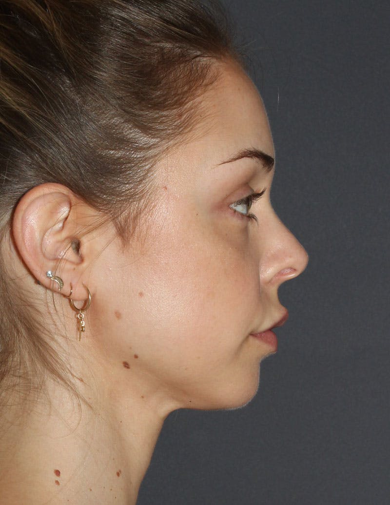 Facetite Before & After Gallery - Patient 298127 - Image 6