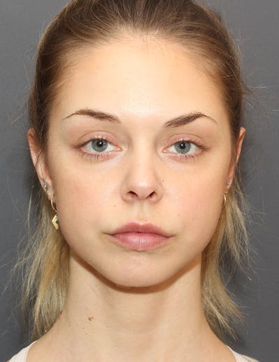 Facetite Before & After Gallery - Patient 298127 - Image 2
