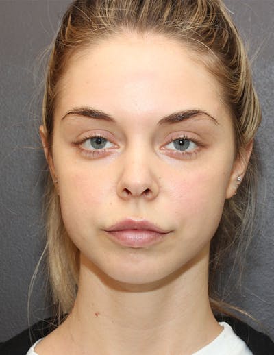 Facetite Before & After Gallery - Patient 298127 - Image 1