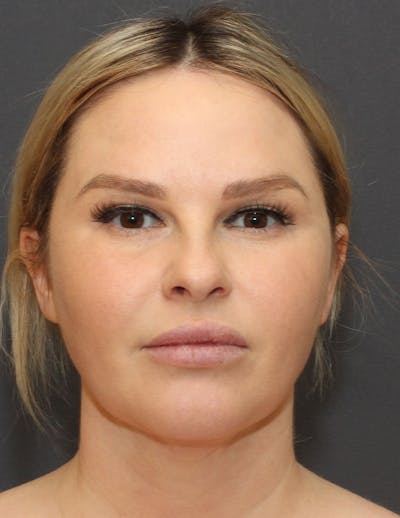 Facetite Before & After Gallery - Patient 398422 - Image 2