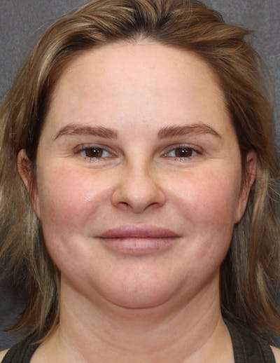 Facetite Before & After Gallery - Patient 398422 - Image 1