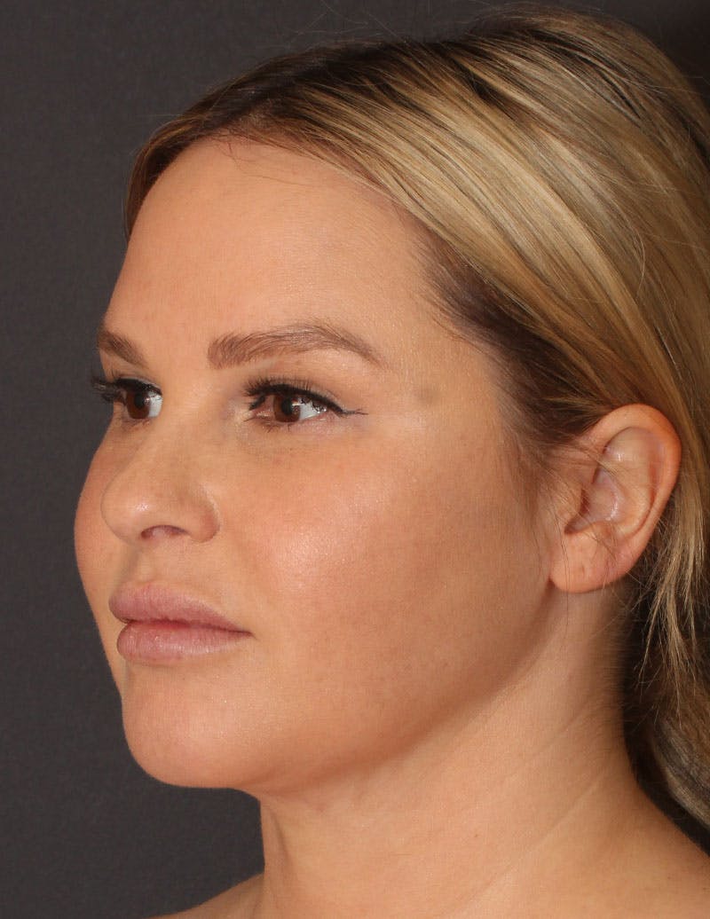 Facetite Before & After Gallery - Patient 398422 - Image 10