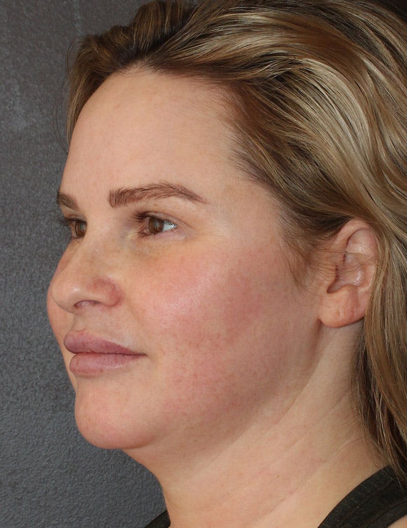 Facetite Before & After Gallery - Patient 398422 - Image 9