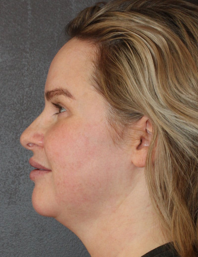 Facetite Before & After Gallery - Patient 398422 - Image 7