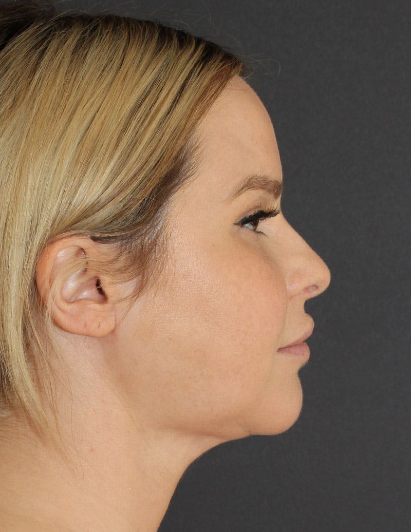Facetite Before & After Gallery - Patient 398422 - Image 6