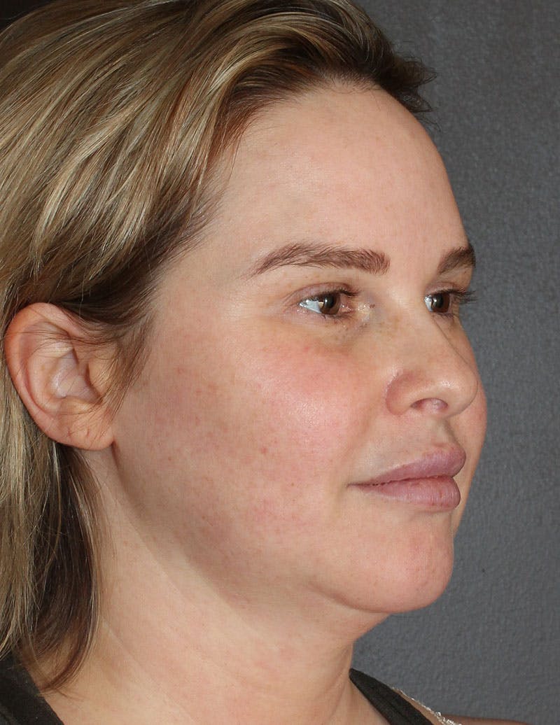 Facetite Before & After Gallery - Patient 398422 - Image 3