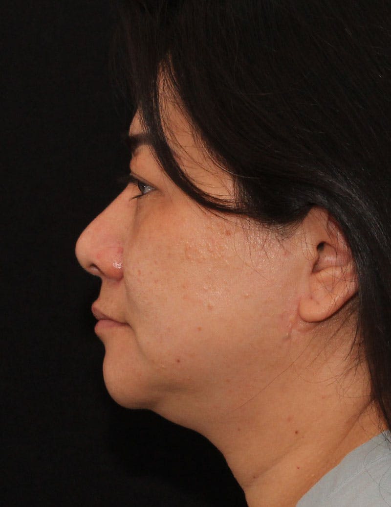 Facetite Before & After Gallery - Patient 760223 - Image 7