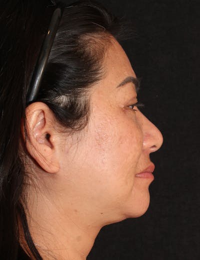 Facetite Before & After Gallery - Patient 760223 - Image 2