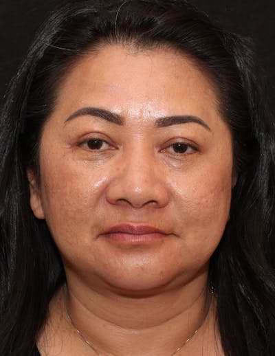 Facetite Before & After Gallery - Patient 760223 - Image 2