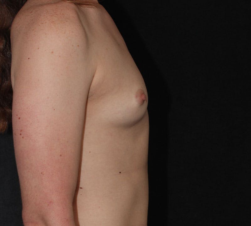 Transgender Breast Augmentation Before & After Gallery - Patient 416925 - Image 5