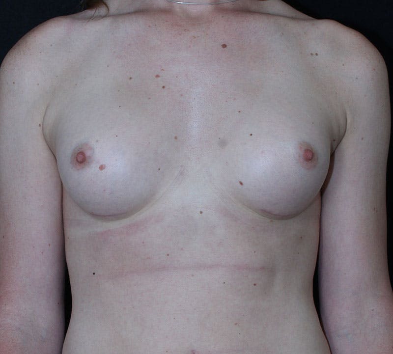 Transgender Breast Augmentation Before & After Gallery - Patient 416925 - Image 2