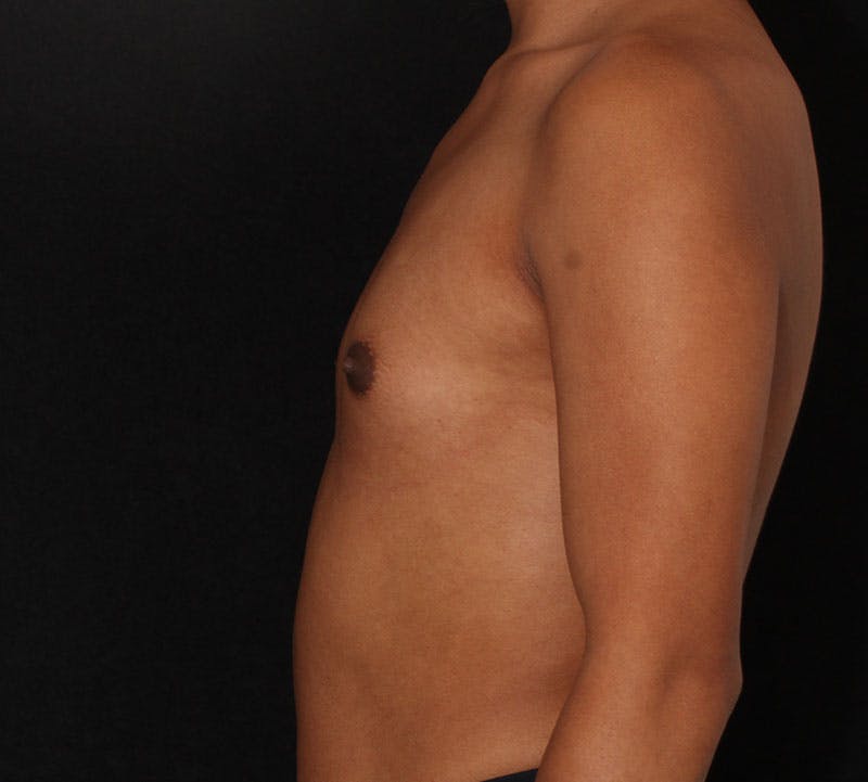 Transgender Breast Augmentation Before & After Gallery - Patient 265799 - Image 7
