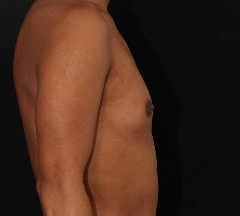 Transgender Breast Augmentation Before & After Gallery - Patient 265799 - Image 5