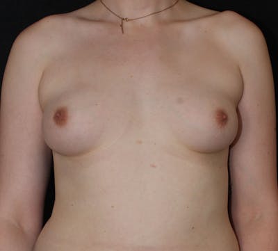 Transgender Breast Augmentation Before & After Gallery - Patient 345339 - Image 1
