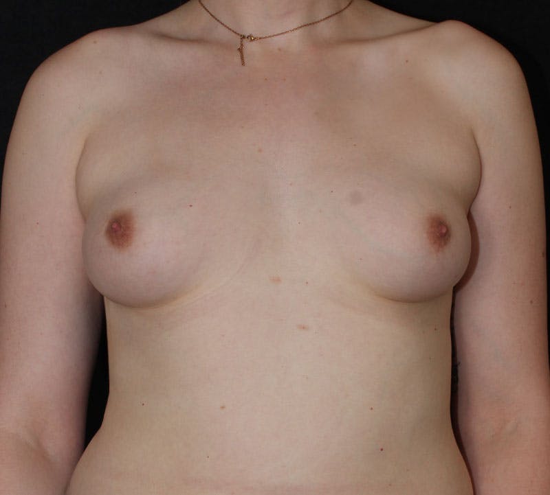 Transgender Breast Augmentation Before & After Gallery - Patient 345339 - Image 1