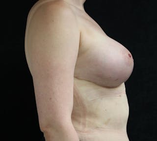 Transgender Breast Augmentation Before & After Gallery - Patient 345339 - Image 6