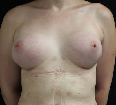 Transgender Breast Augmentation Before & After Gallery - Patient 345339 - Image 2